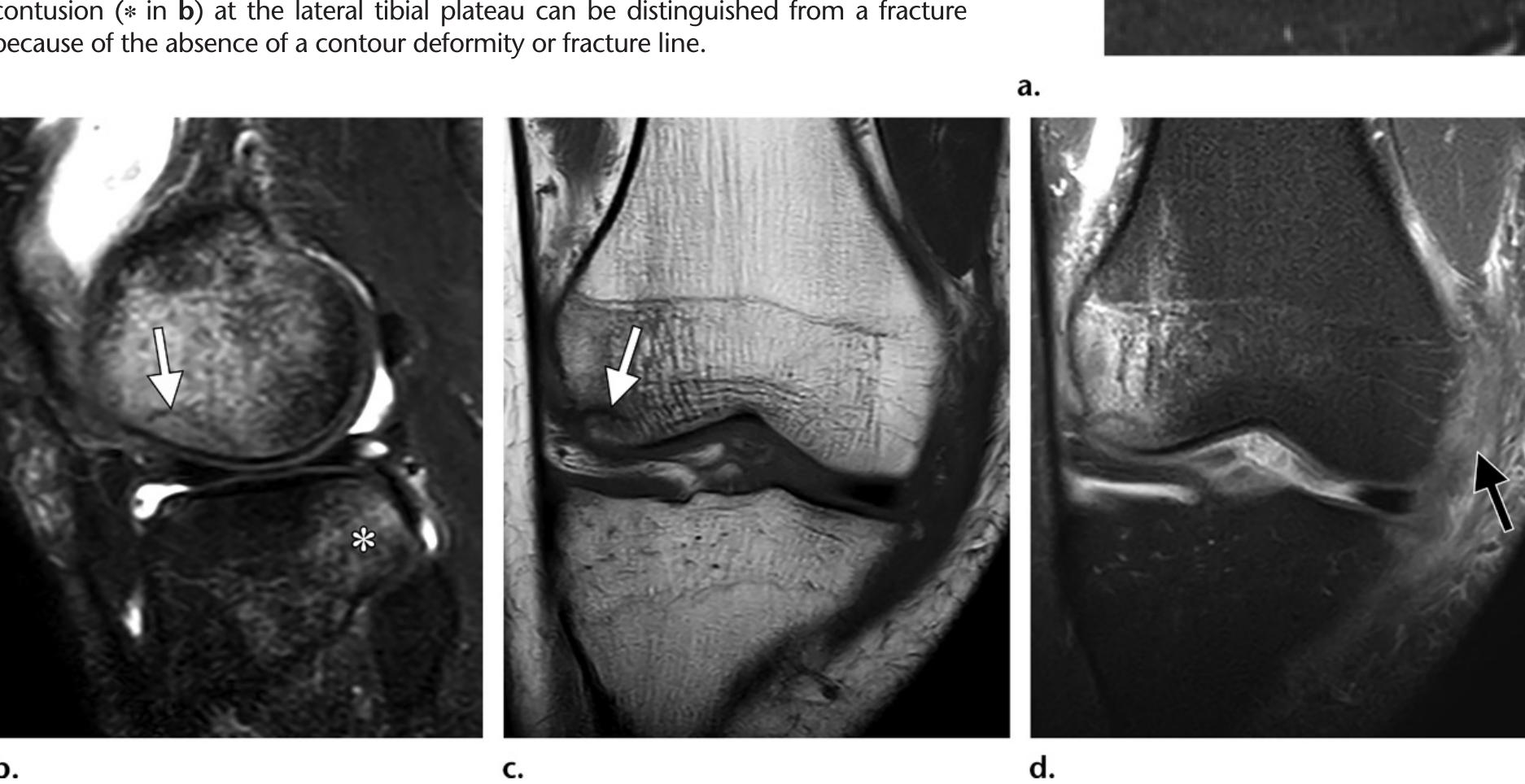Figure 3 - from Osteochondral Lesions of the Knee: