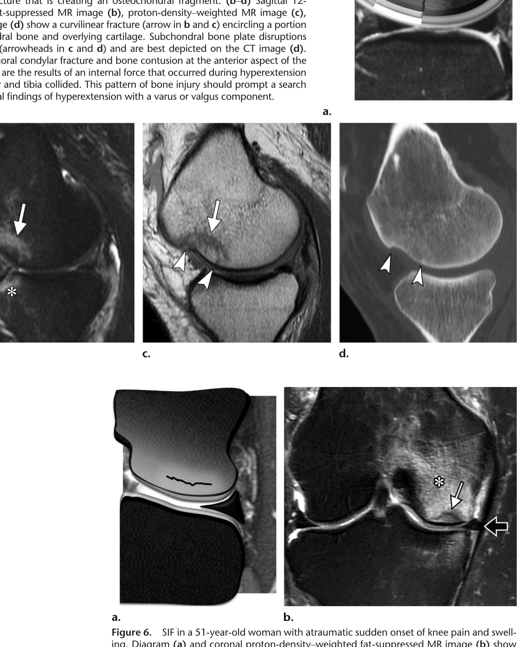 Figure 5 - Osteochondral Lesions of the Knee: