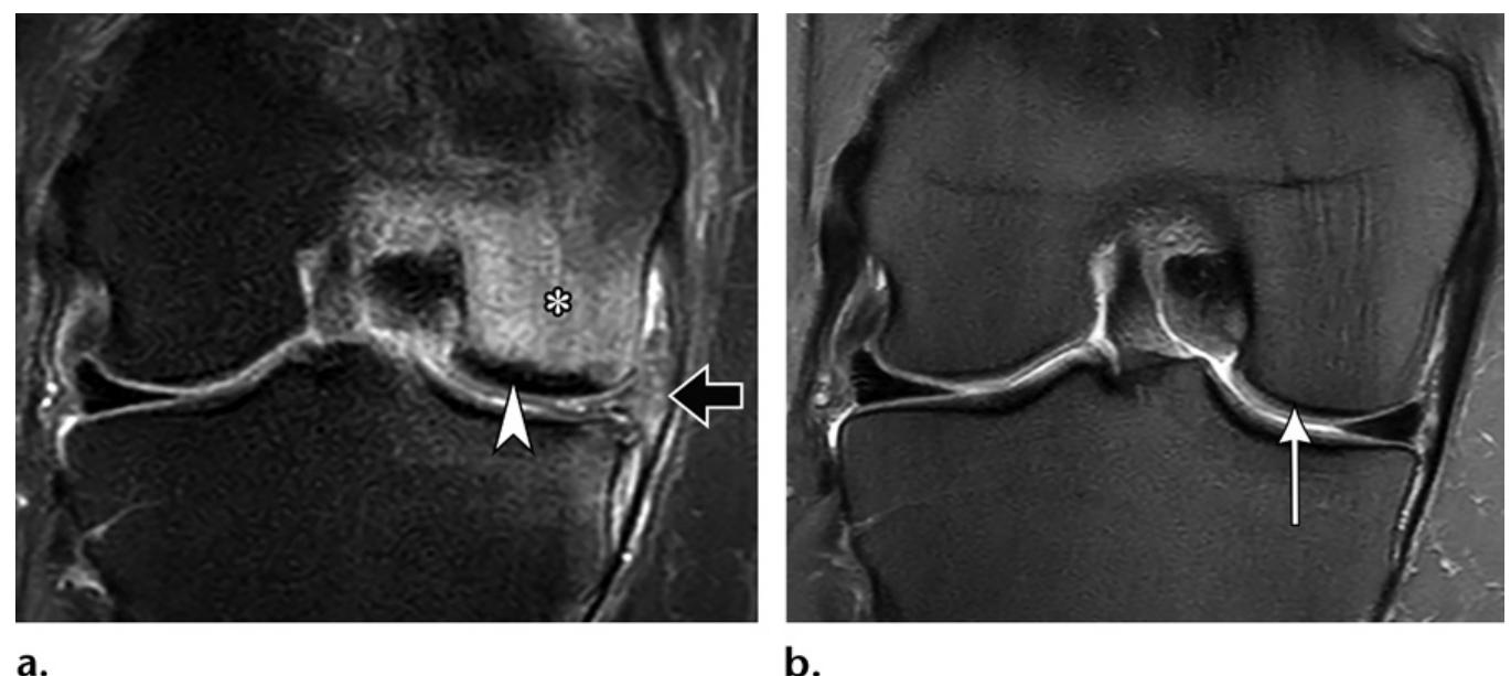 PDF Osteochondral Lesions Of The Knee Differentiating The Most pdf-osteochondral-lesions-of-the-knee-differentiating-the-most