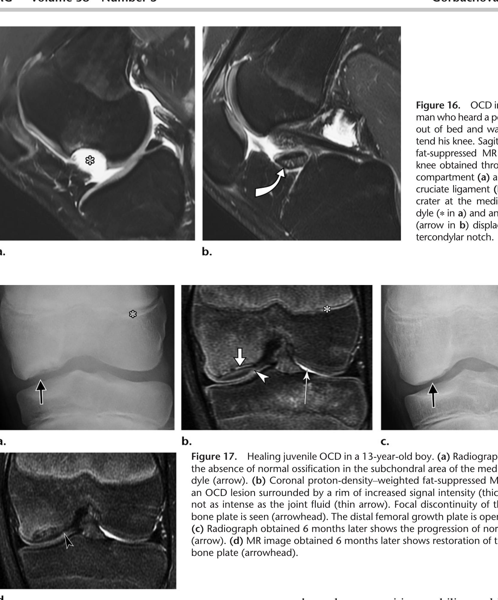 (PDF) Osteochondral Lesions of the Knee: Differentiating the Most ...