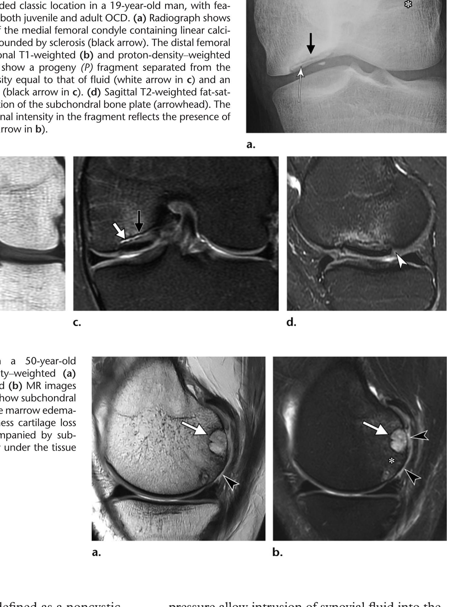 (PDF) Osteochondral Lesions of the Knee: Differentiating the Most ...