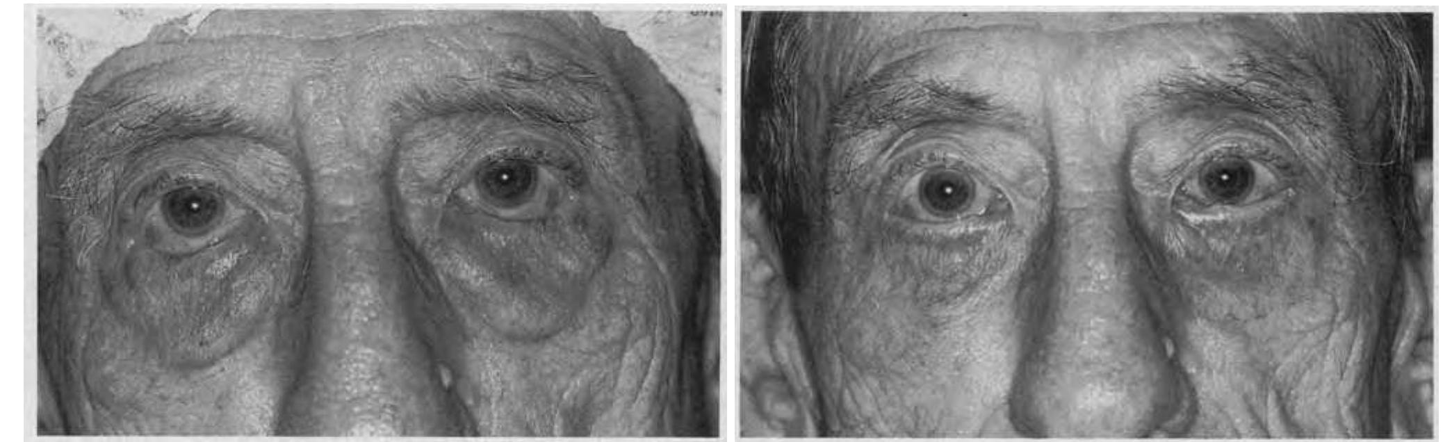 Parsectomy (PDF) Transconjunctival Entropion Repair
