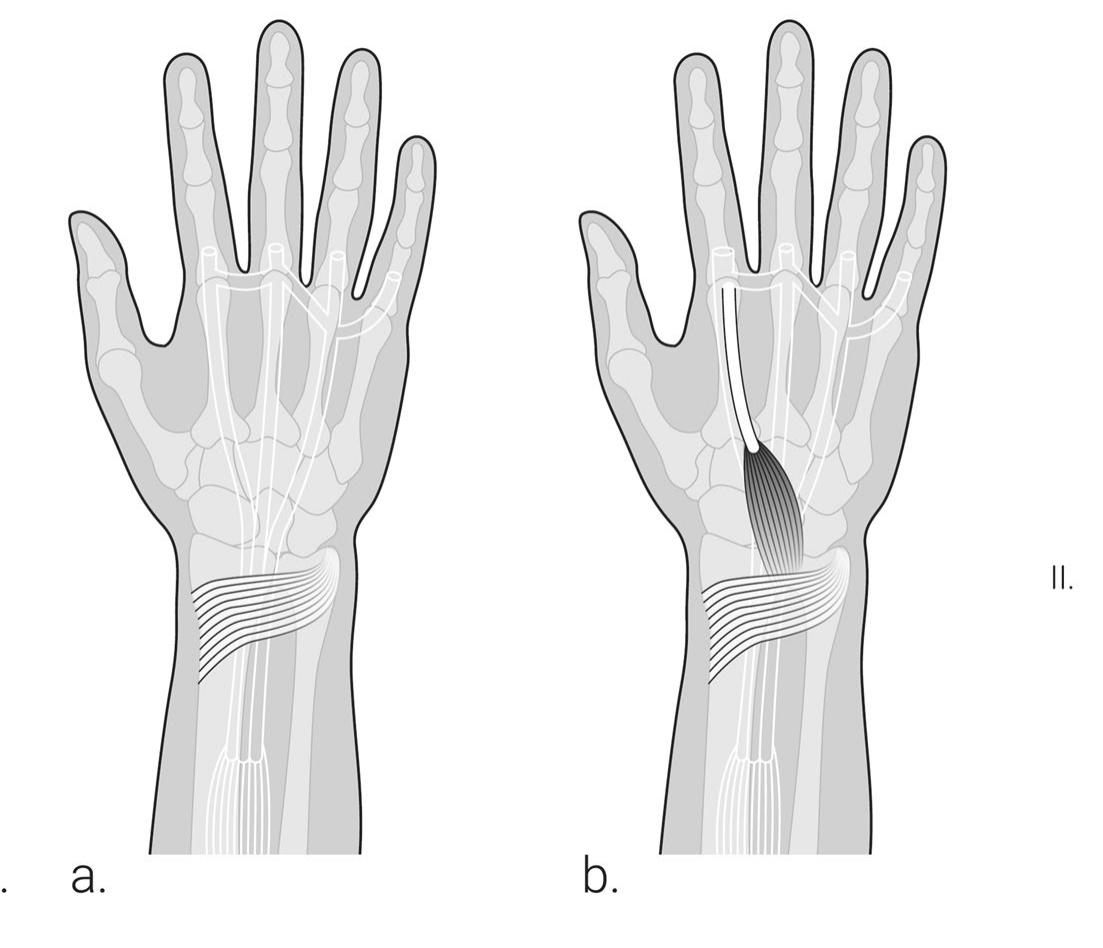 (PDF) Extensor indicis proprius muscle and its variants together with ...