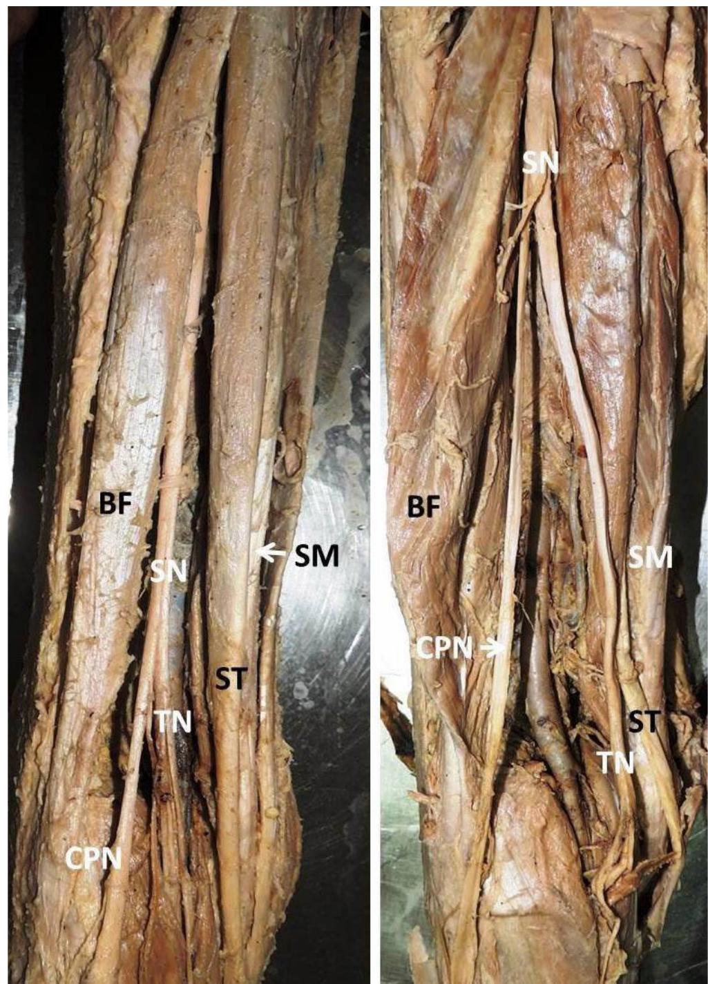(PDF) Variations of the sciatic nerve and its relation with the ...