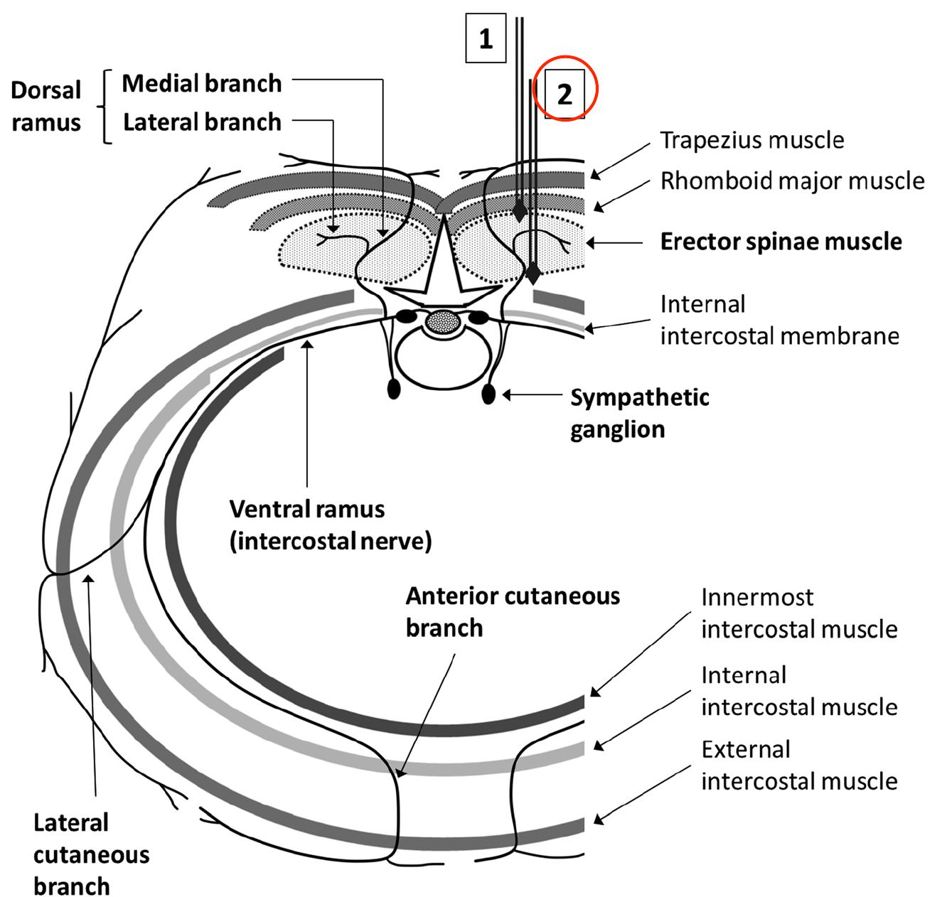 (PDF) The Erector Spinae Plane Block: A Novel Analgesic Technique in ...