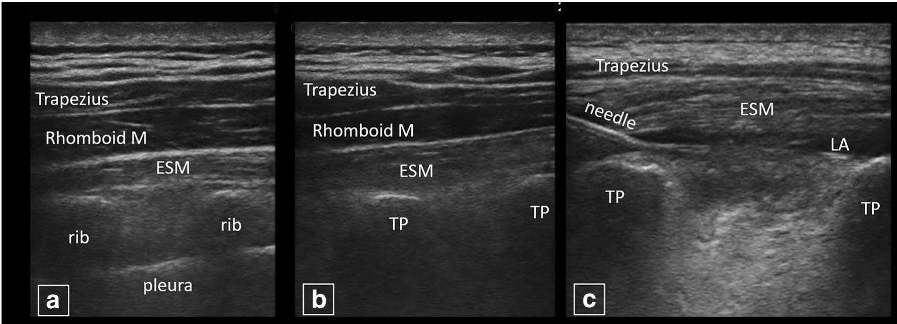 Floating Rib Ultraosund A parasagittal ultrasound view of the proximal ribs which