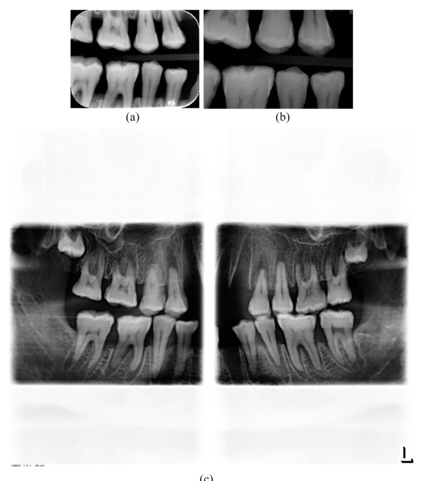 (PDF) Intraoralversusextraoral bitewing radiography in detection of ...