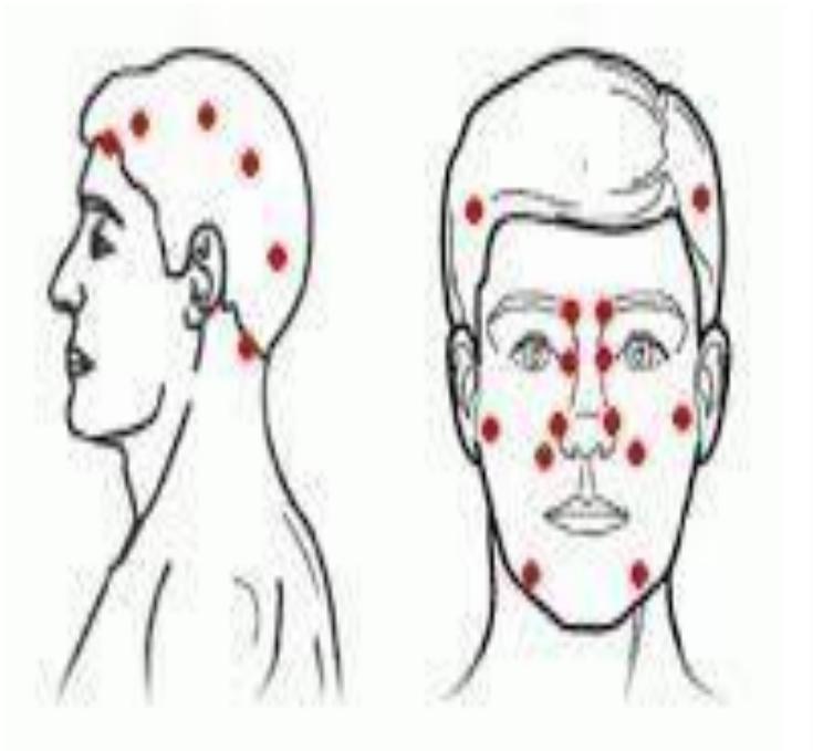 (PDF) Non Invasive Treatment to Relieve the Pain due to Headaches ...