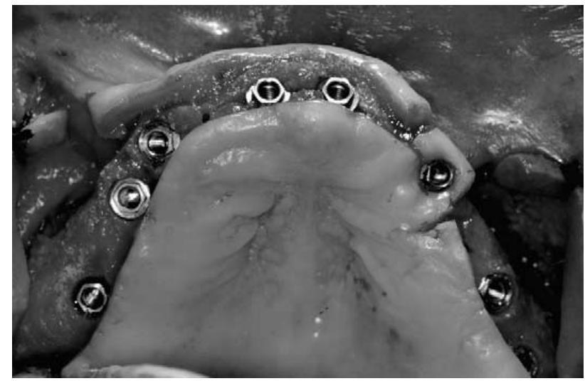 Maxillary Ridge Split An occlusal view following maxillary implant placement. note