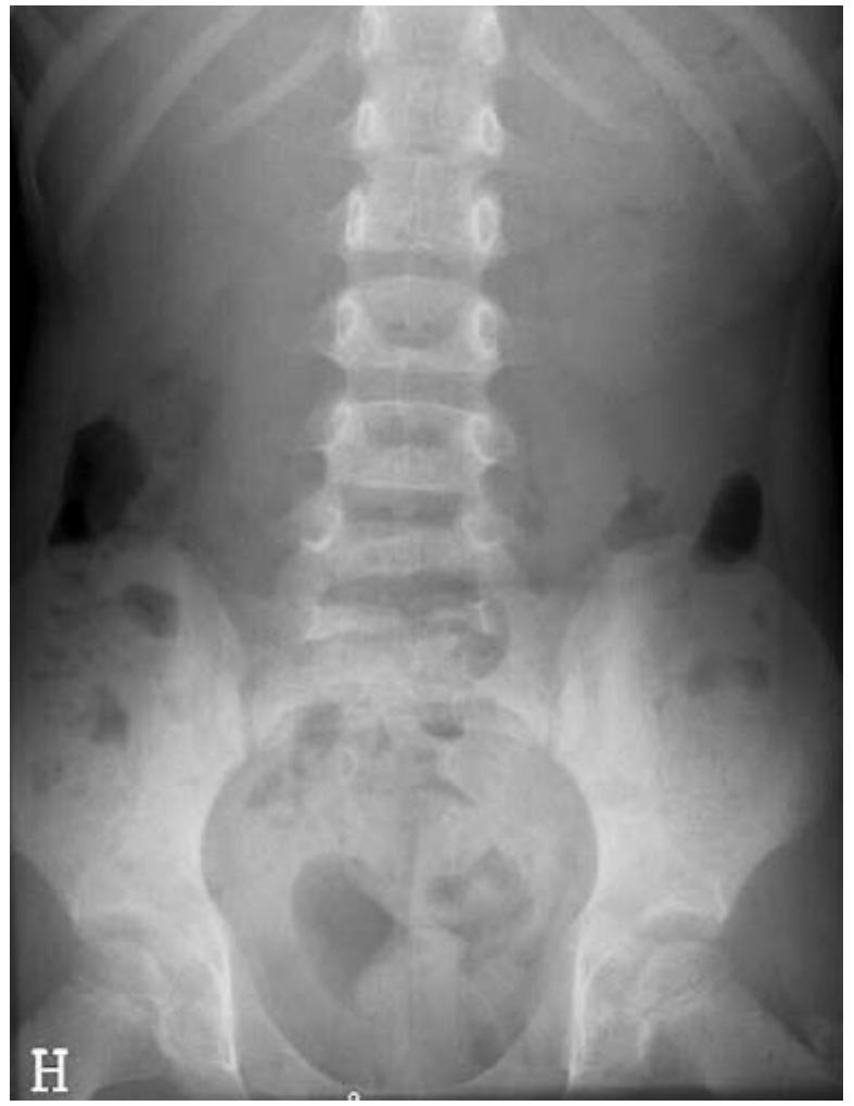 (PDF) Imaging strategies in children with suspected appendicitis