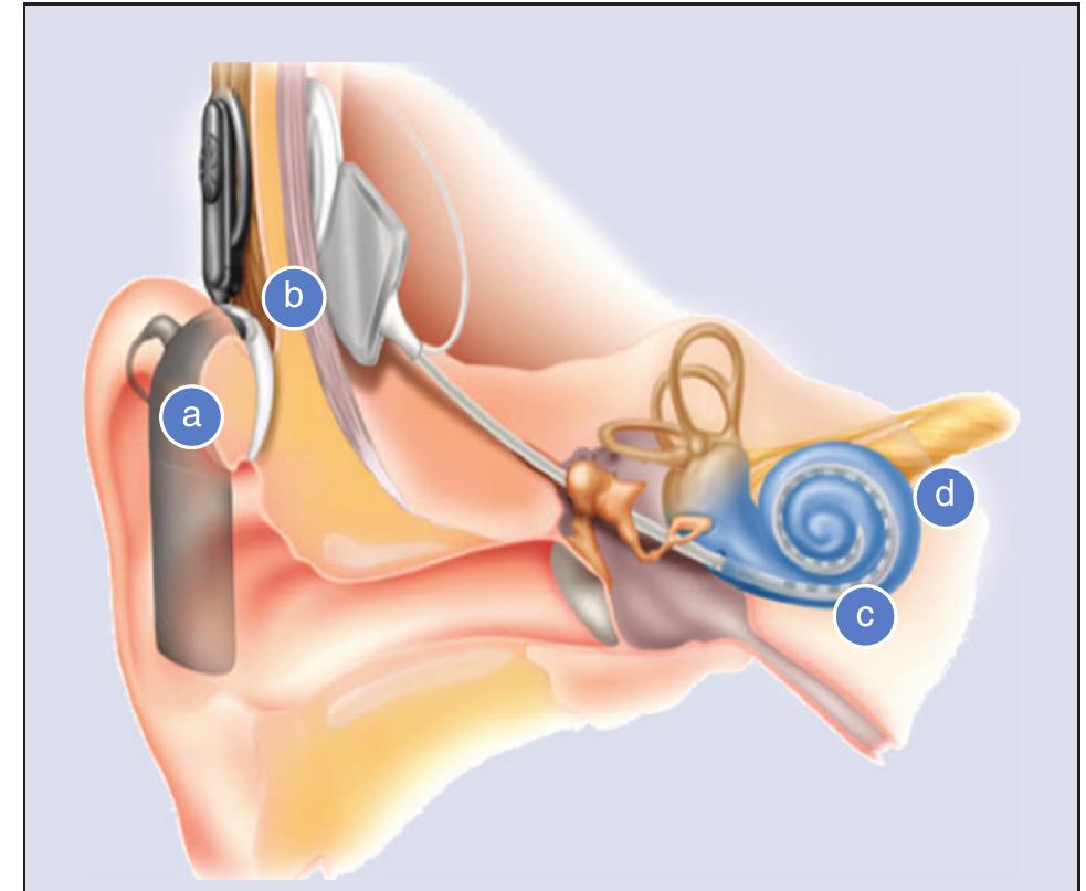 (PDF) Engineering Challenges in Cochlear Implants Design and Practice