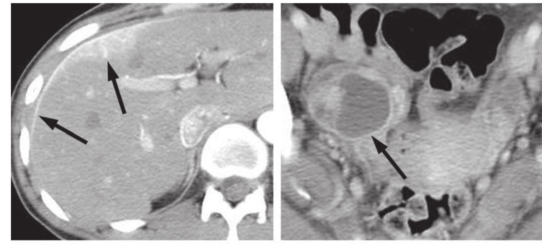 (PDF) Hepatic Capsular and Subcapsular Pathologic Conditions ...