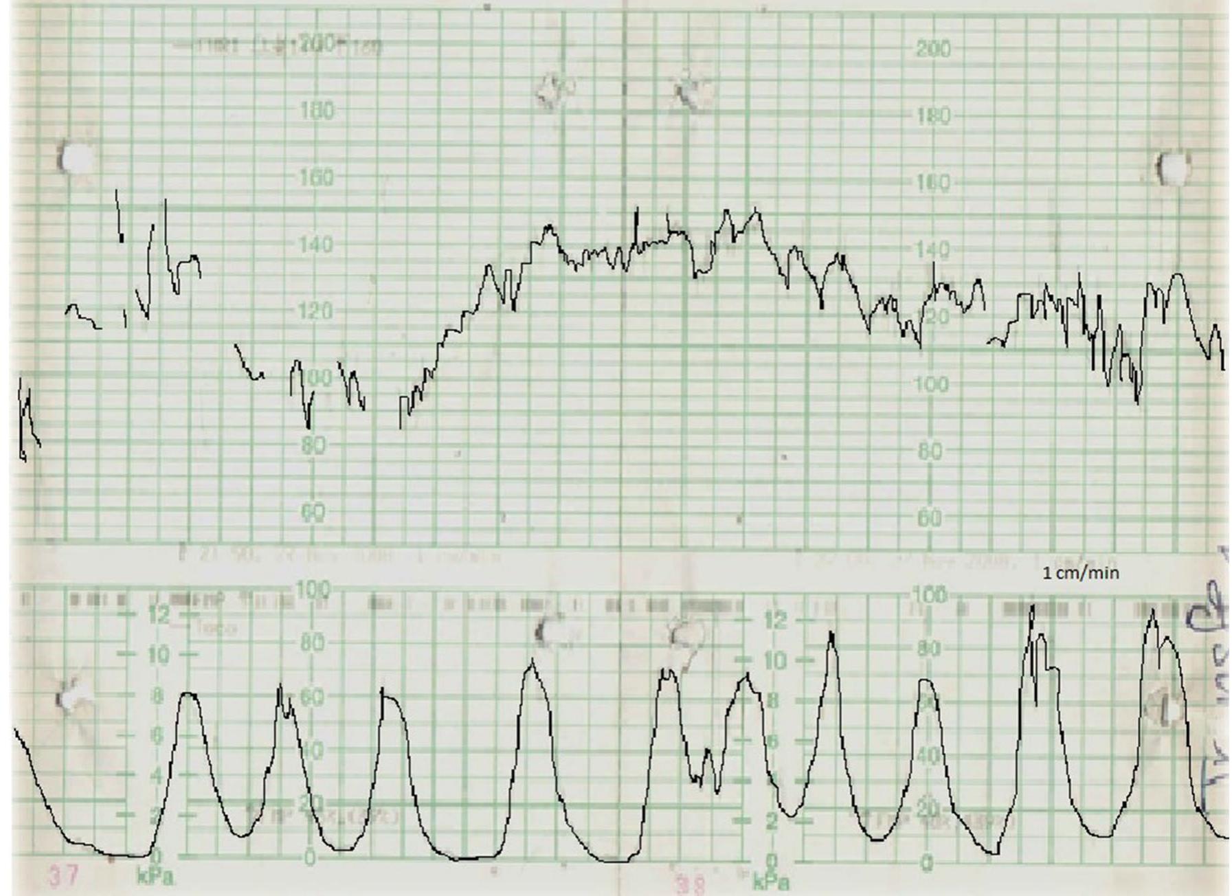 (PDF) Signal Ambiguity and Misinterpretation of Fetal Heart Rate: A ...