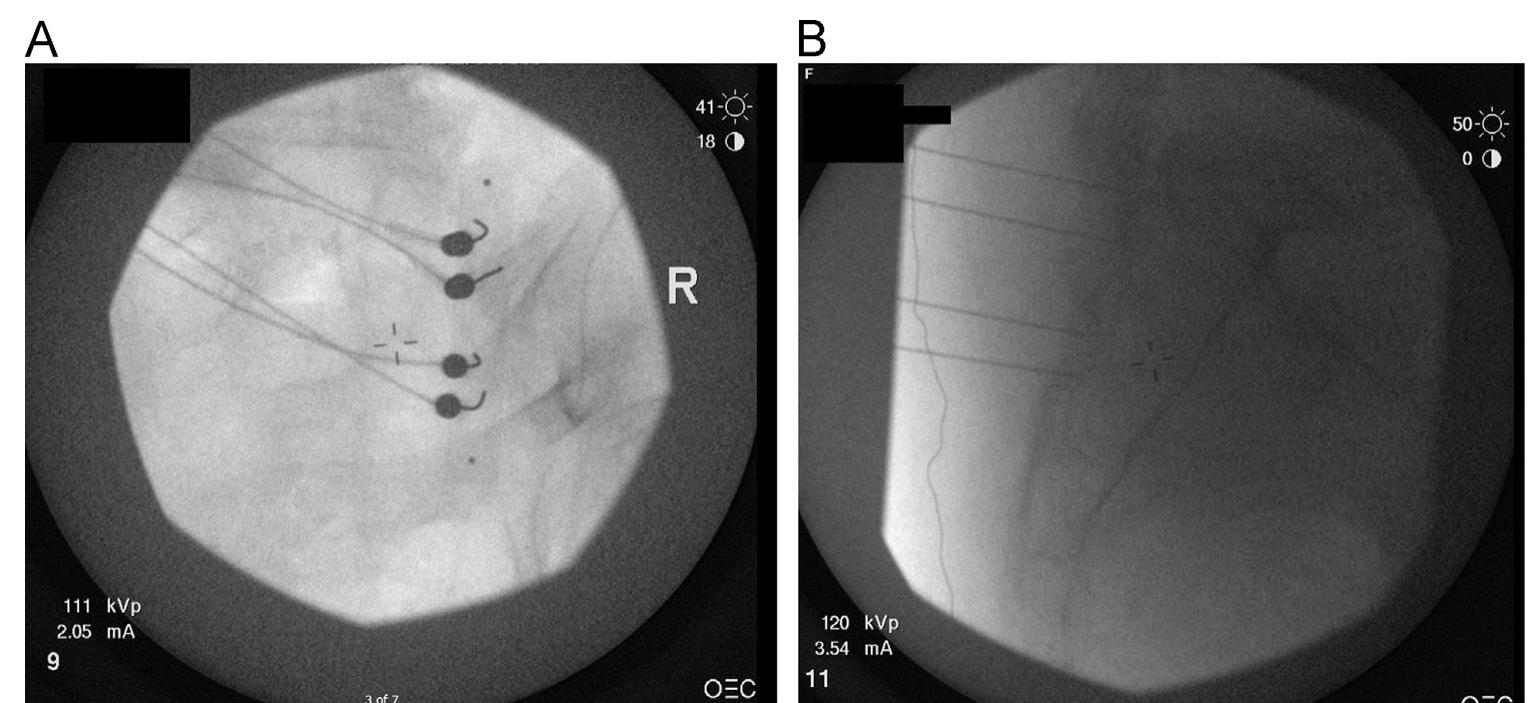 Sacral Rfa (PDF) Radiofrequency ablation of the sacral lateral branches