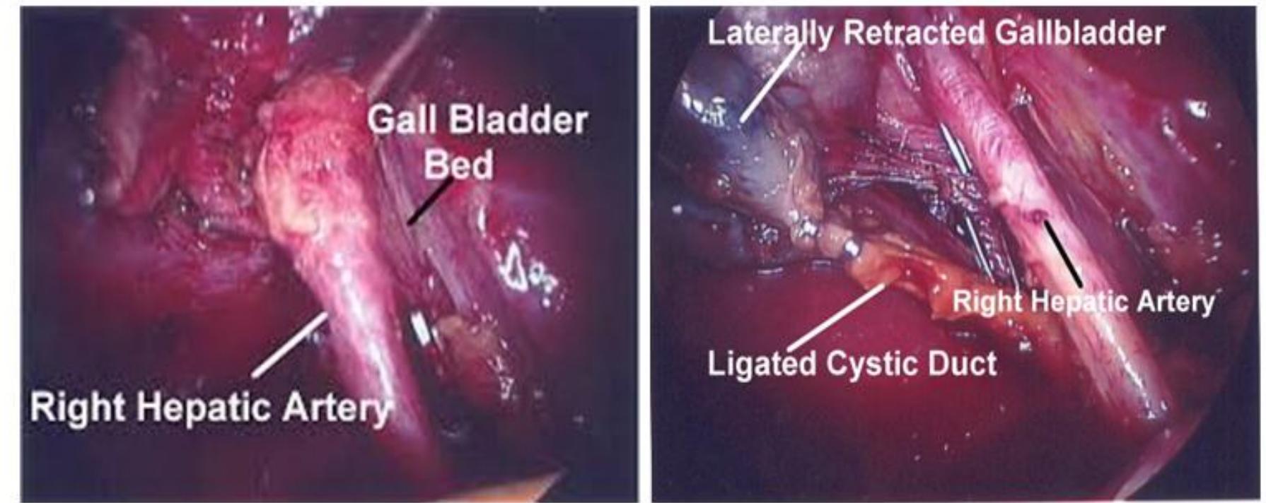 (PDF) STUDY ON THE ANATOMIC VARIATIONS OF CYSTIC ARTERY DURING ...