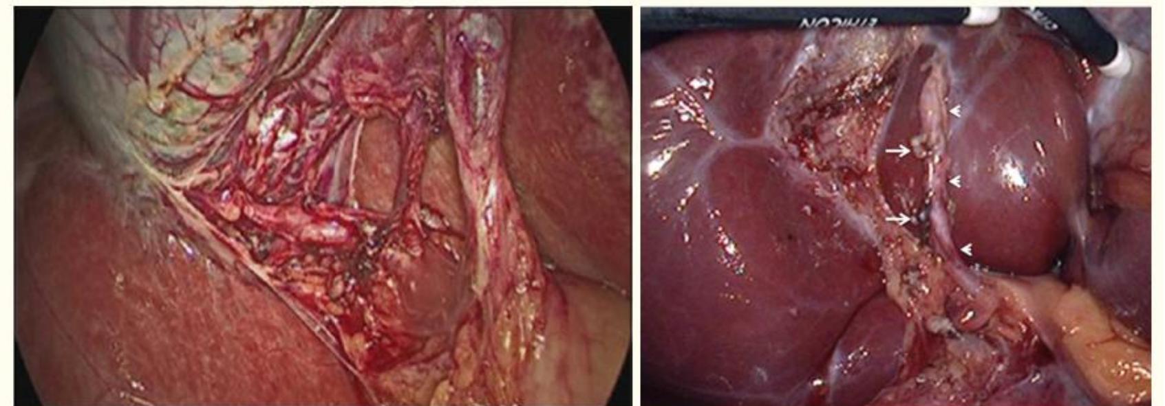 (PDF) STUDY ON THE ANATOMIC VARIATIONS OF CYSTIC ARTERY DURING ...