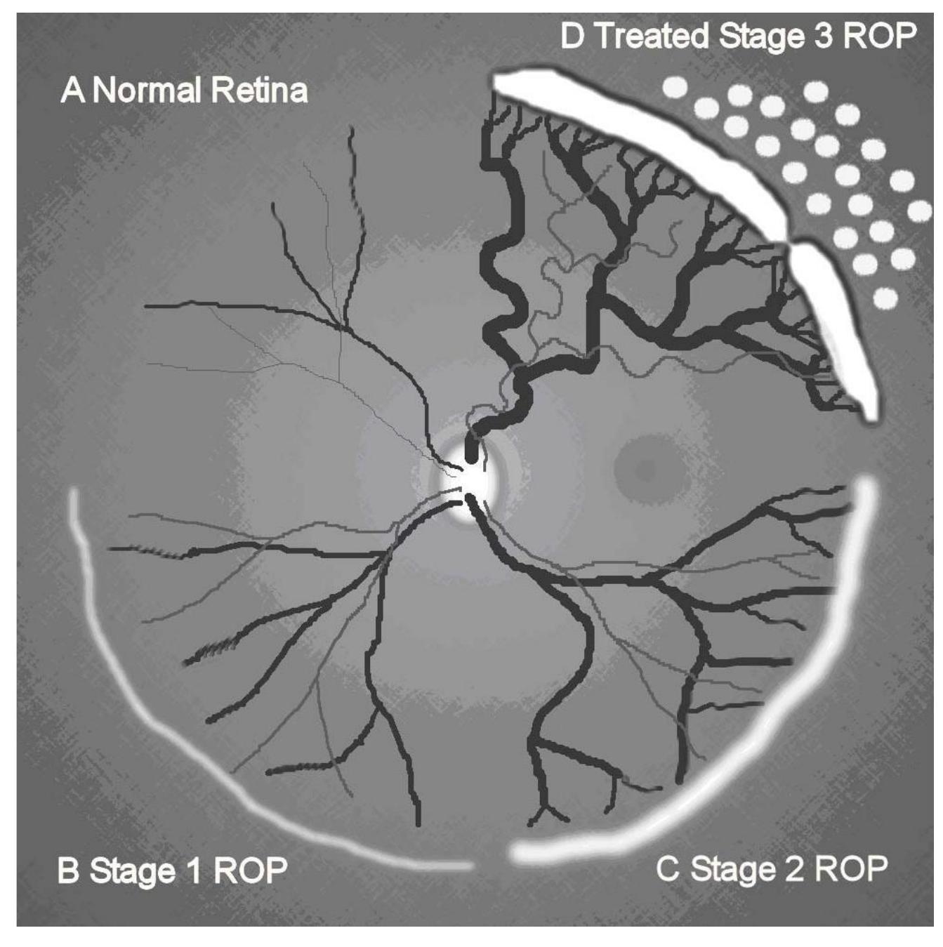 (PDF) [Screening retinopathy of prematurity (ROP)]