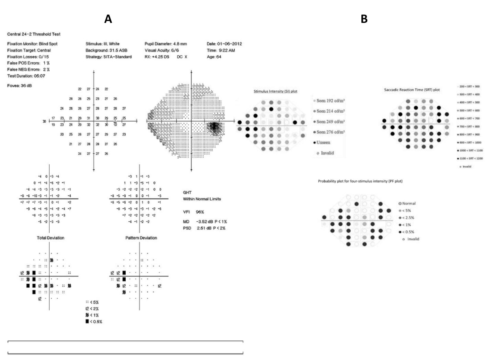 (PDF) Visual Field Responsiveness in Glaucoma: An eye tracking approach