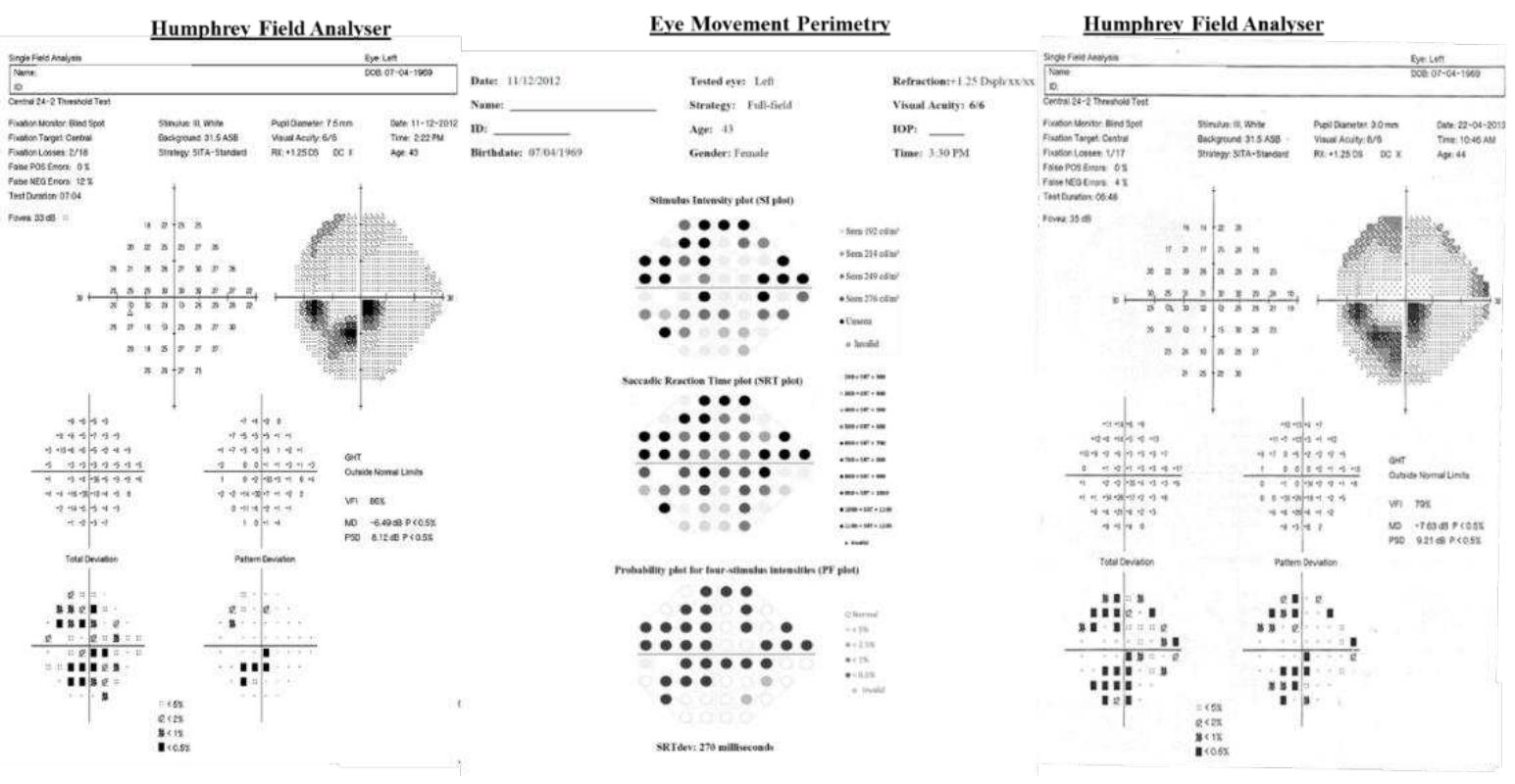(PDF) Visual Field Responsiveness in Glaucoma: An eye tracking approach