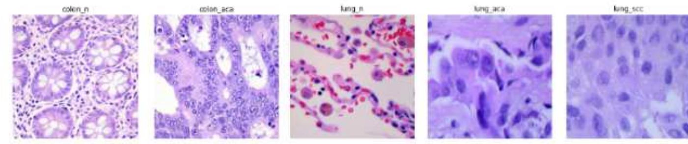 (PDF) Lung and colon cancer detection from CT images using Deep Learning