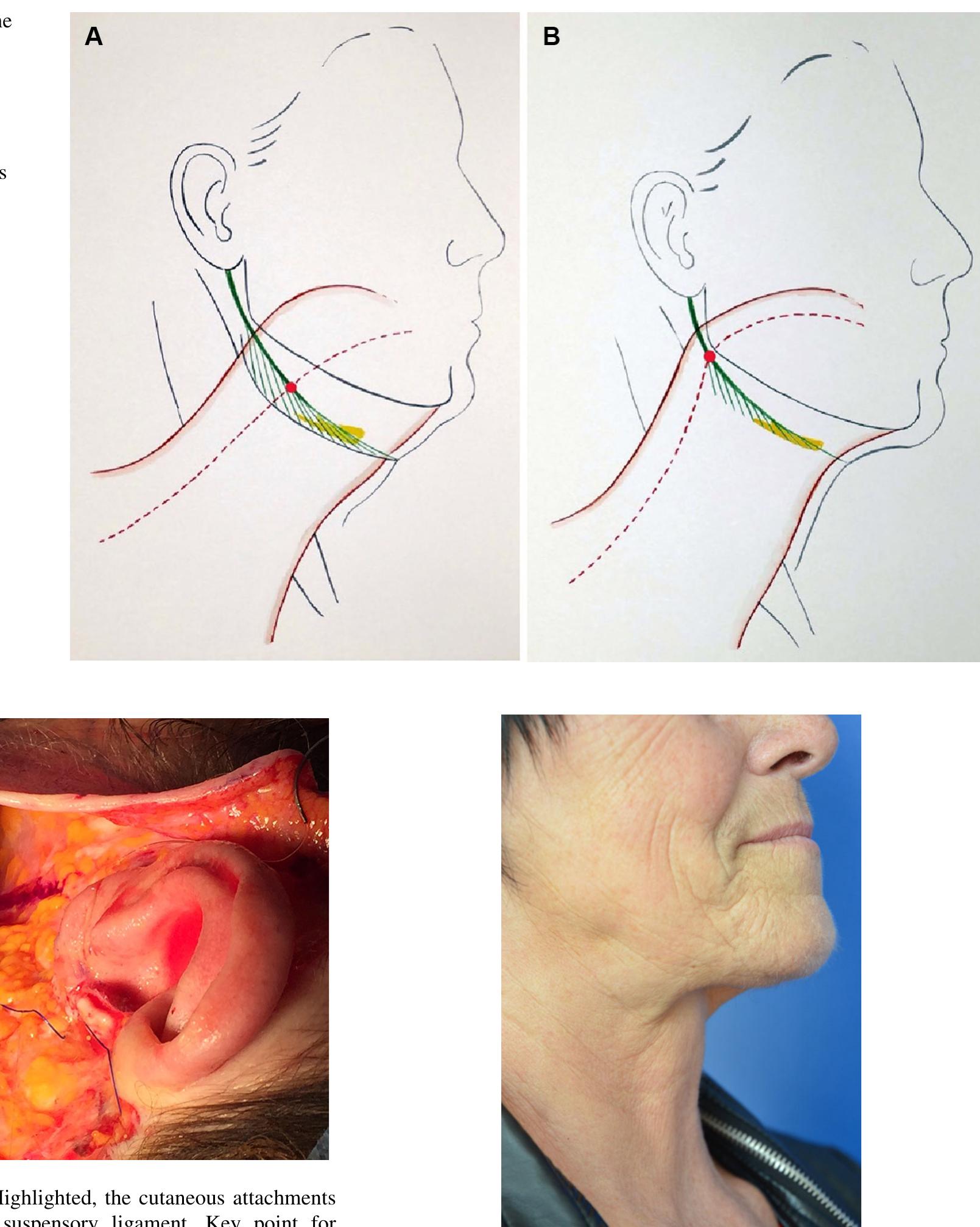 (PDF) Cervico-Mental Angle Suspensory Ligament: The Keystone to ...