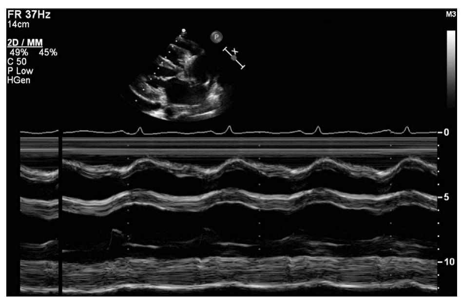 Tte Views Review Course (a) subcostal 4-chamber view of the preoperative tte showing
