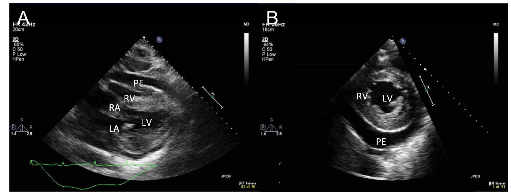 (a) subcostal 4-chamber view of the preoperative tte showing