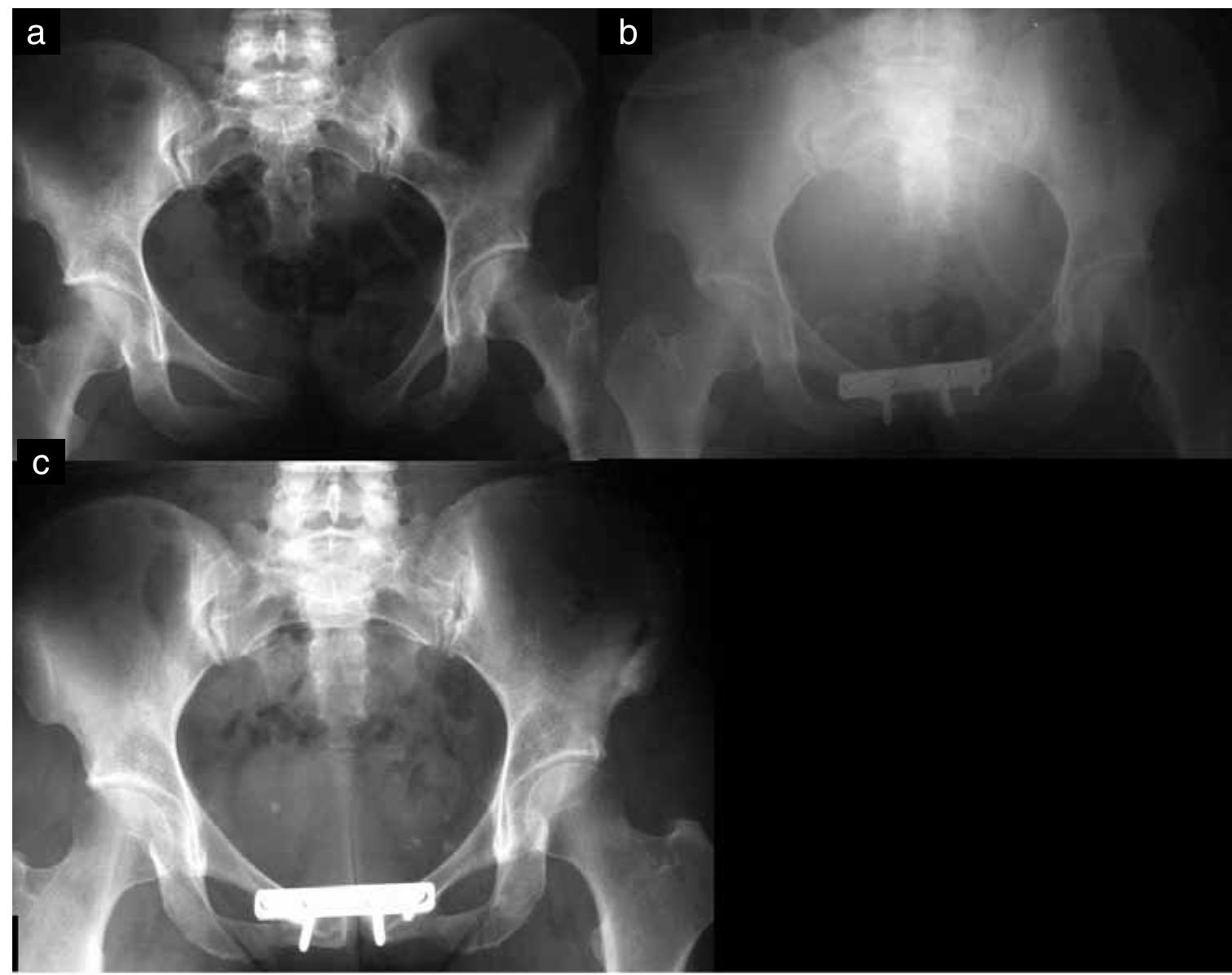 Proxamately (PDF) Evaluation Tools and Outcomes after Osteosynthesis of Unstable ...