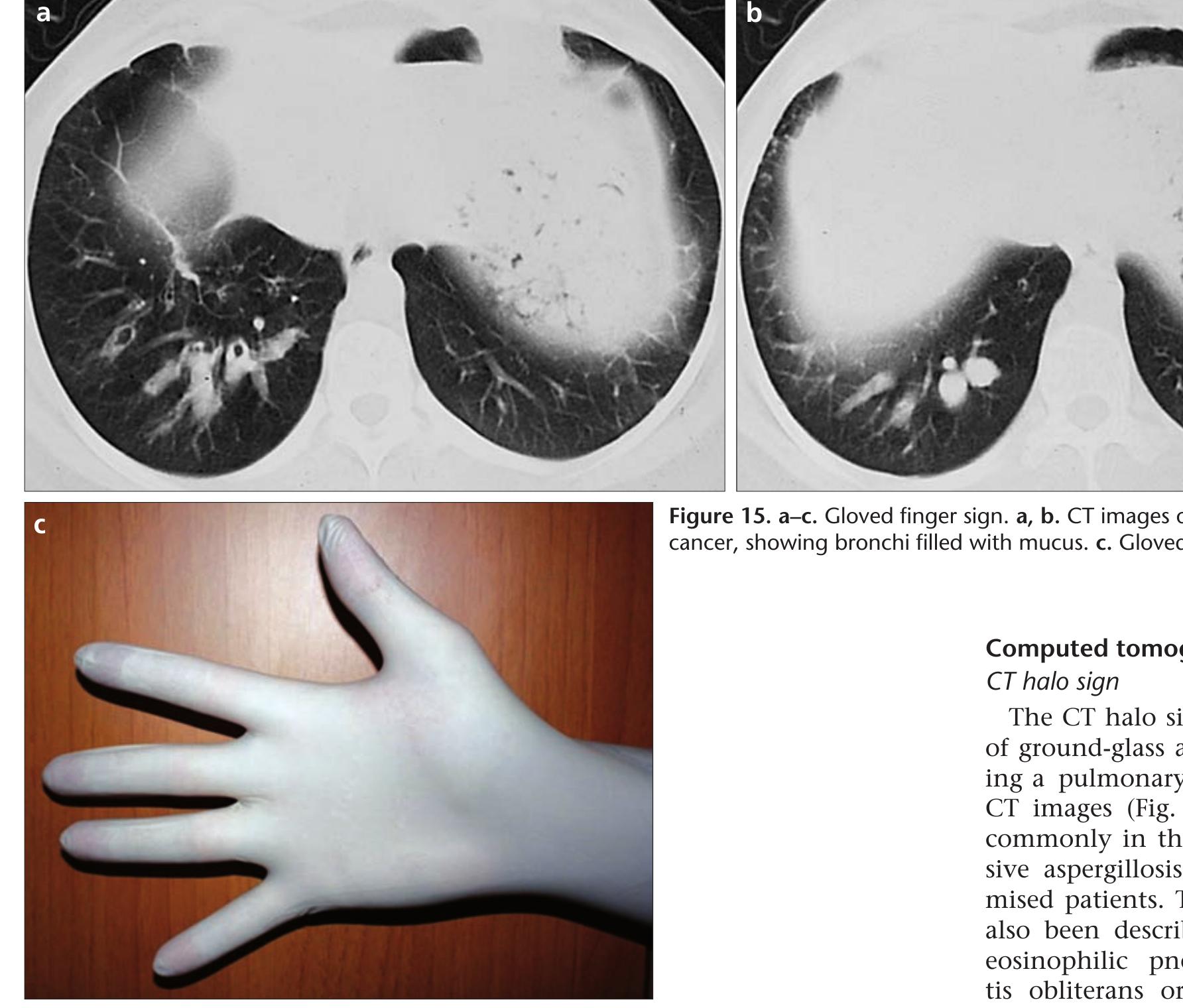 (PDF) Signs in chest imaging: a pictorial review