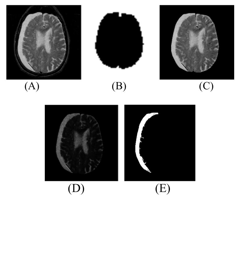 Figure 3 - from Automated Brain Hemorrhage Lesion