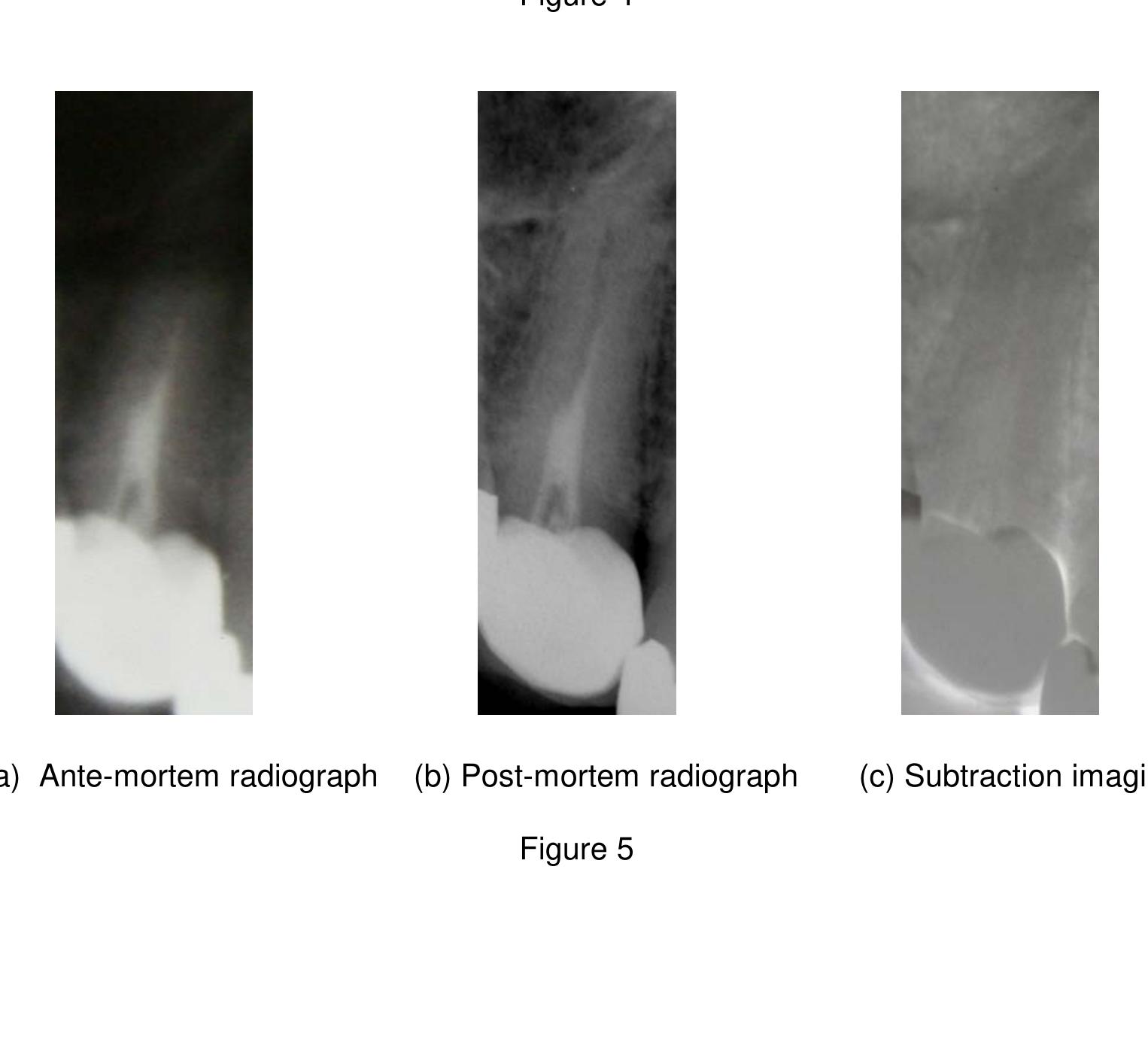 (PDF) Endodontic imaging as an aid to forensic personal identification