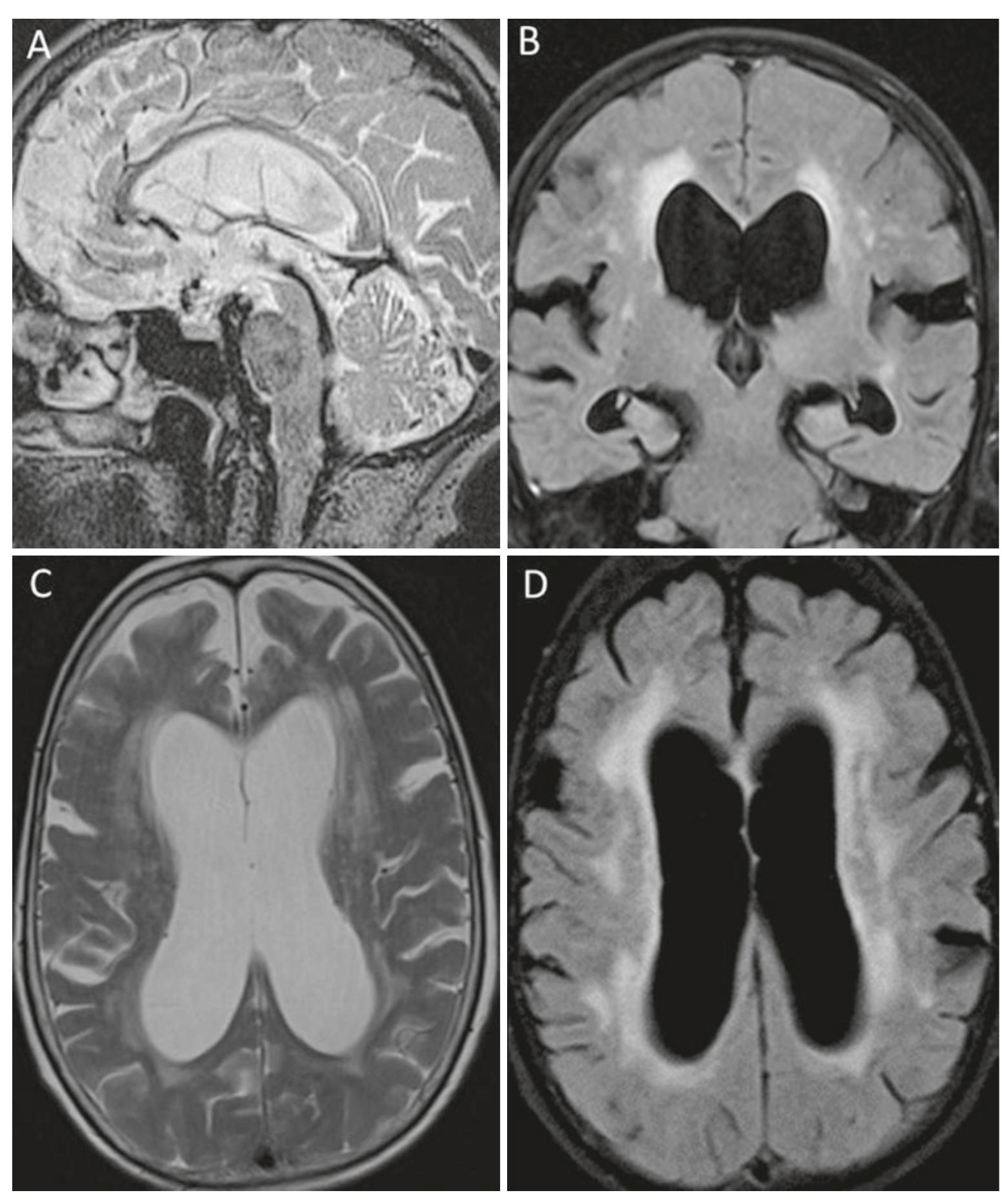 Desh Inph (PDF) Hydrocephalus and CSF Disorders