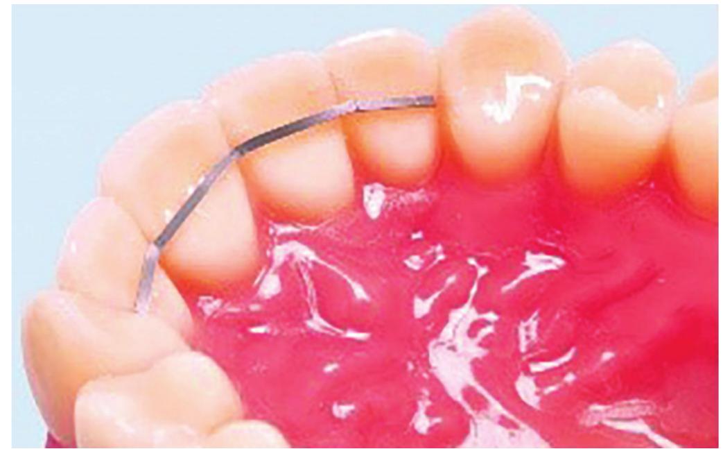Bioforce Archwire (PDF) Orthodontic Archwires: An Update