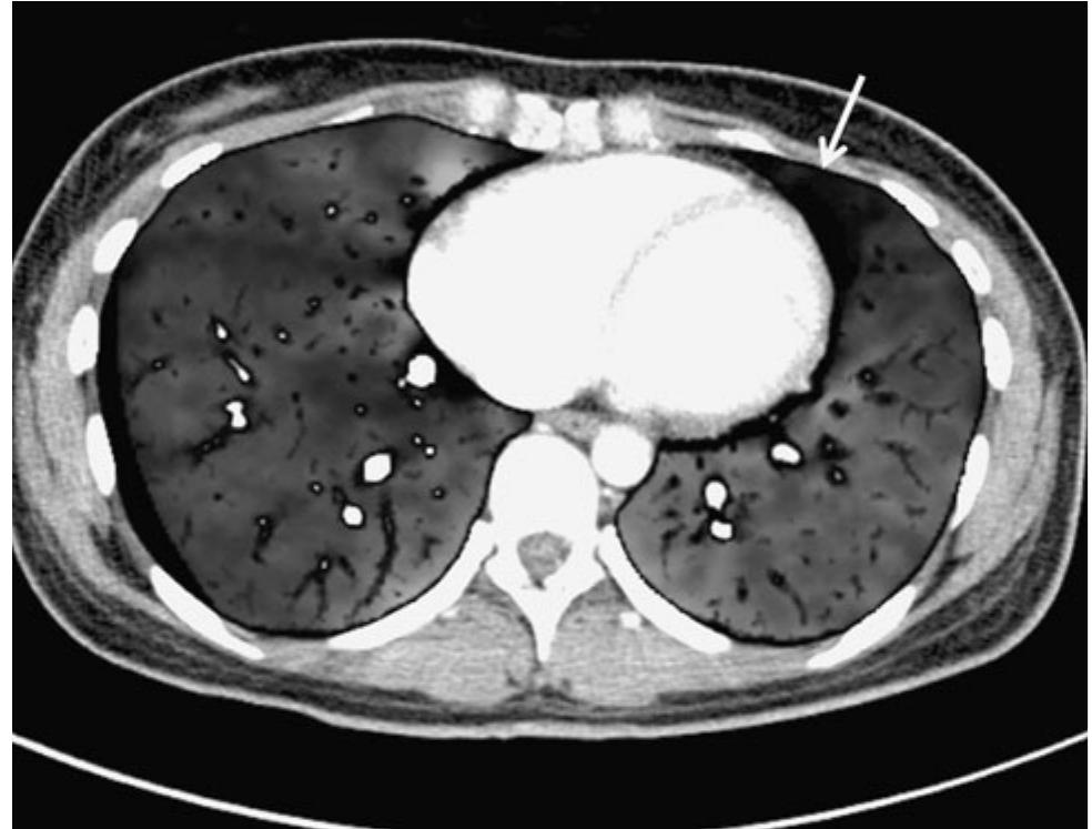(PDF) Dual-energy perfusion CT of non-diseased lung segments using dual ...
