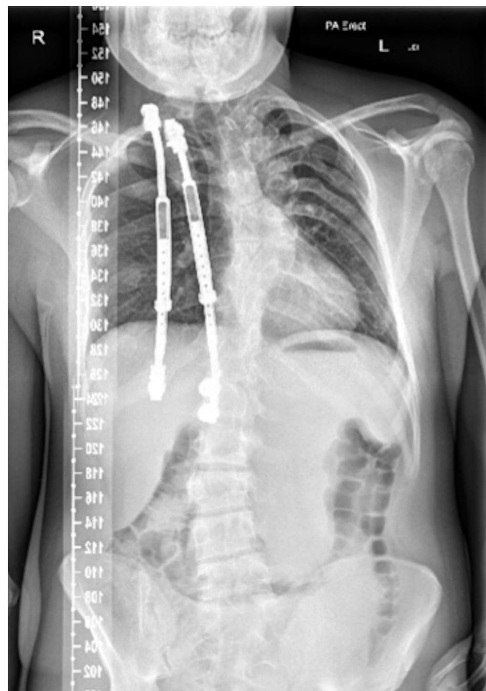Radiograph showing vertical expandable prosthetic titanium