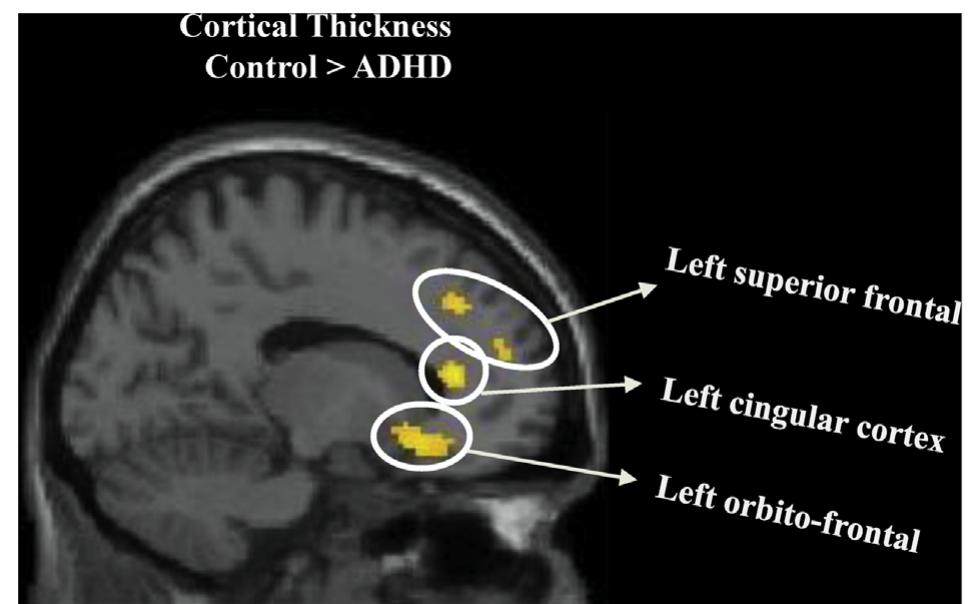 (PDF) Neural alterations in ADHD children as indicated by voxel-based ...