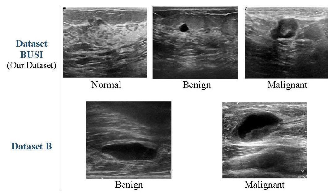 Samples of real images from dataset busi are in the first