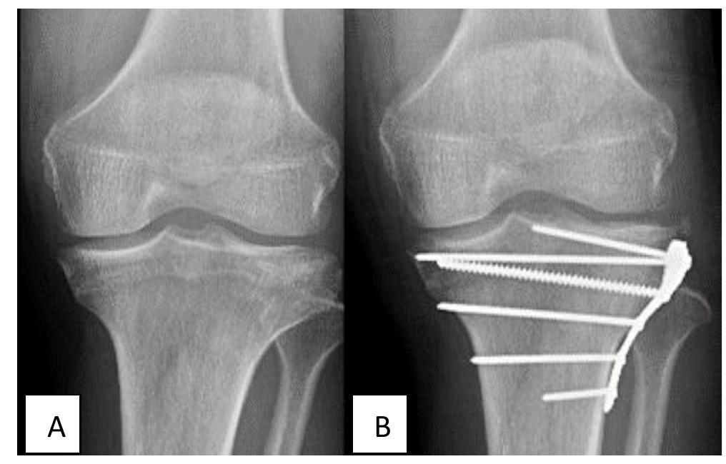 (PDF) Comparative analysis between locking compression plate and Joshi ...