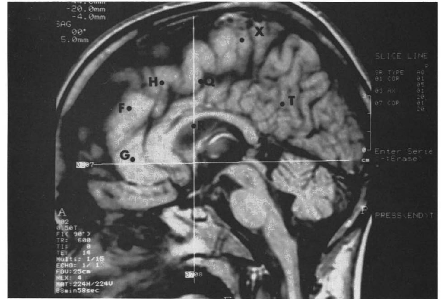 Patient 1. mri sagittal section of the brain passing through