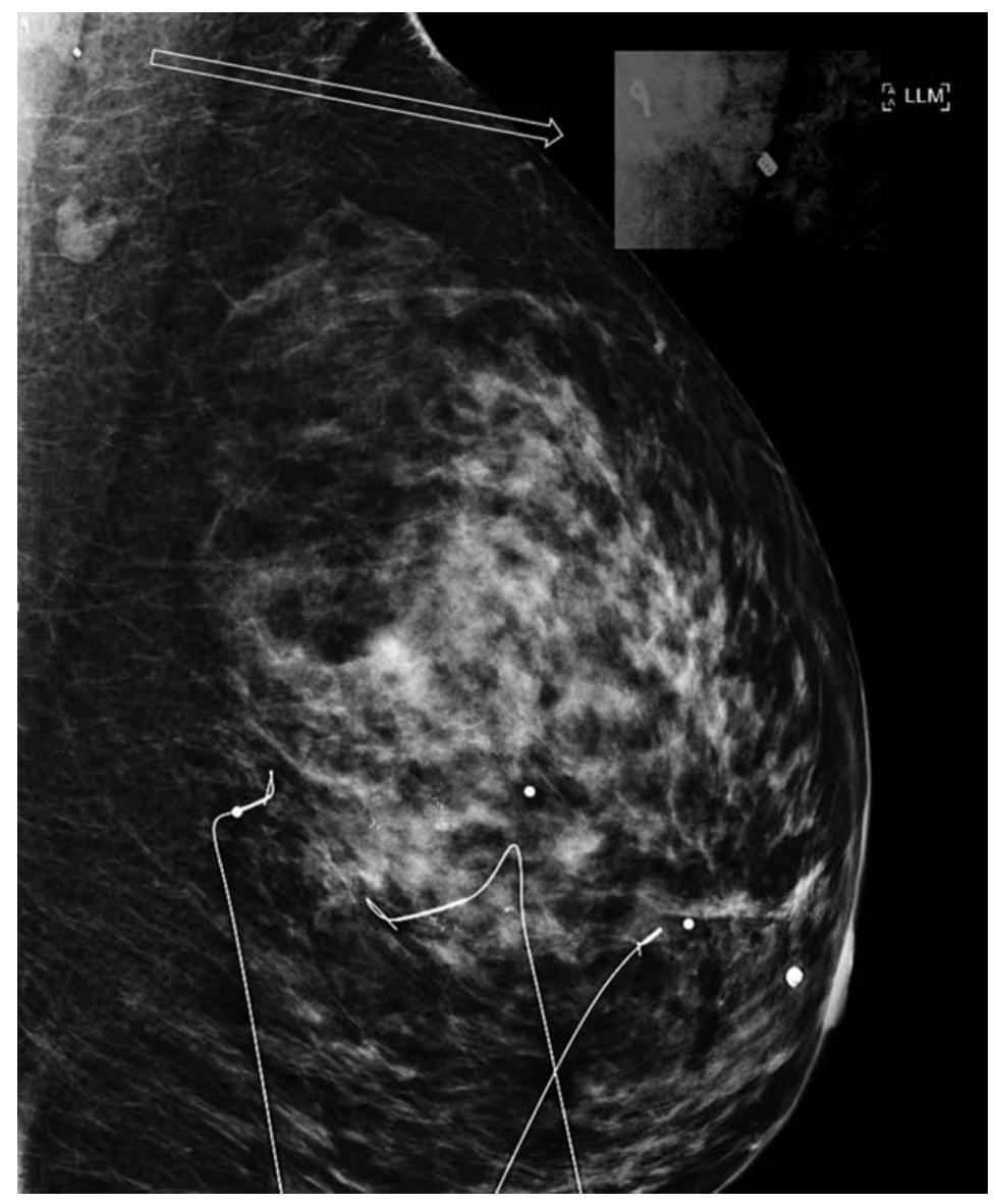 Axillary Clips Figure 6 - from Detectability of Hygroscopic Clips Used in