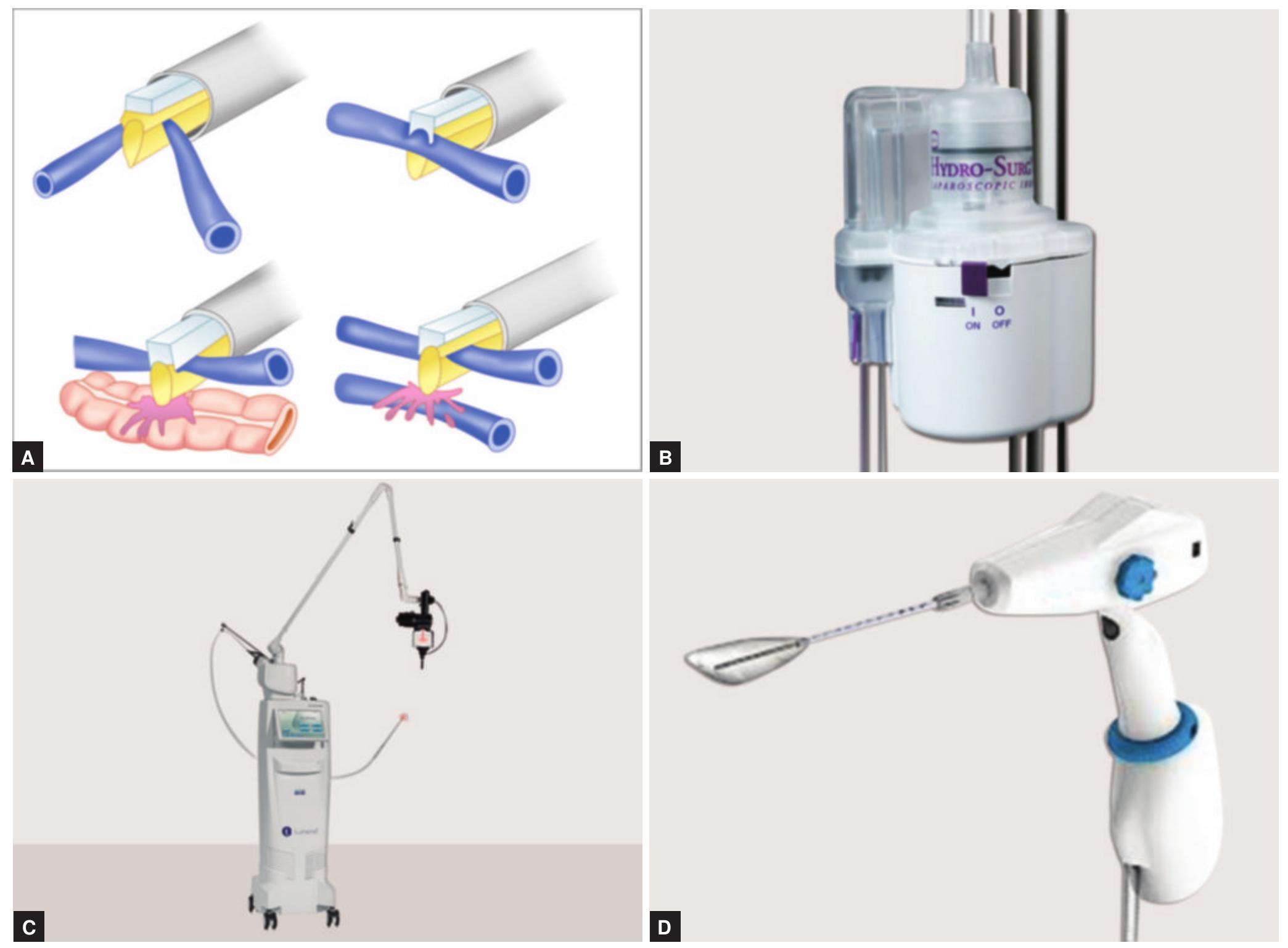 Water Stream Dissection (PDF) Laparoscopic Dissection Technique: Precision and Safety in ...