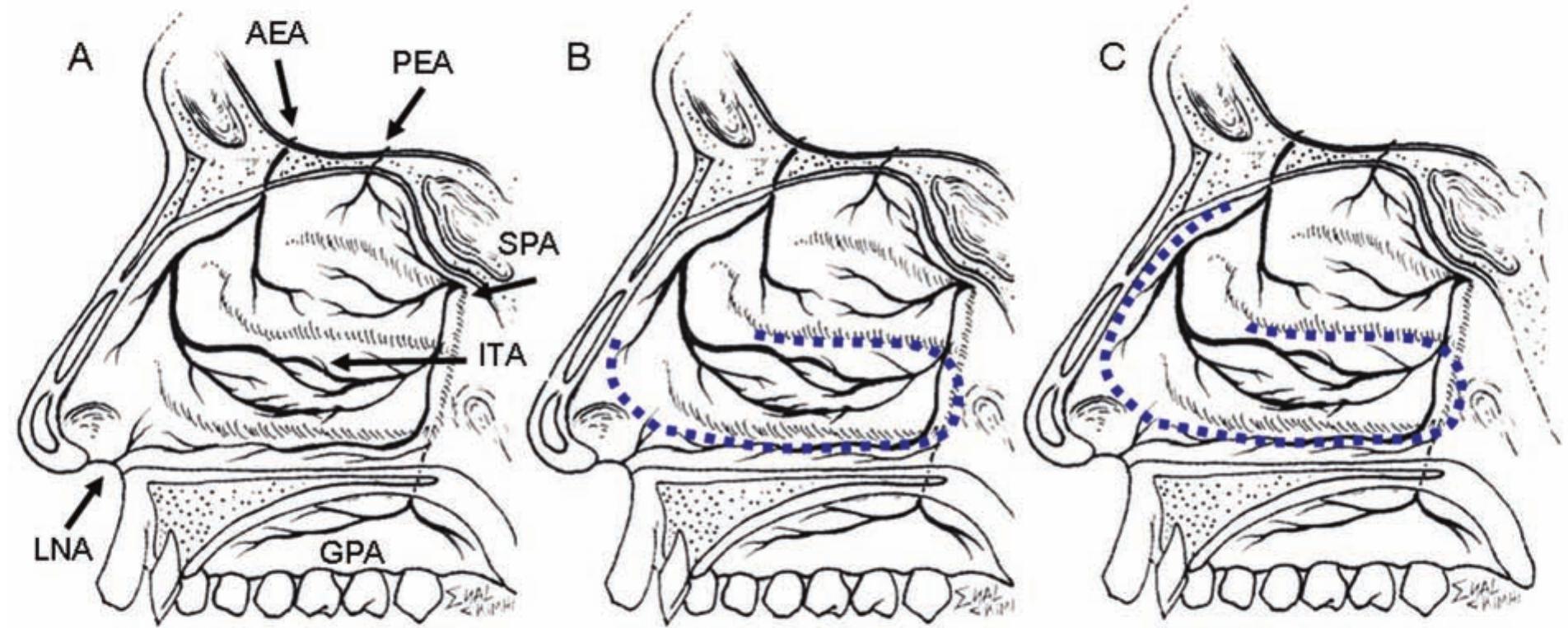 (PDF) Anteriorly Based Inferior Turbinate Flap for Endoscopic Skull ...