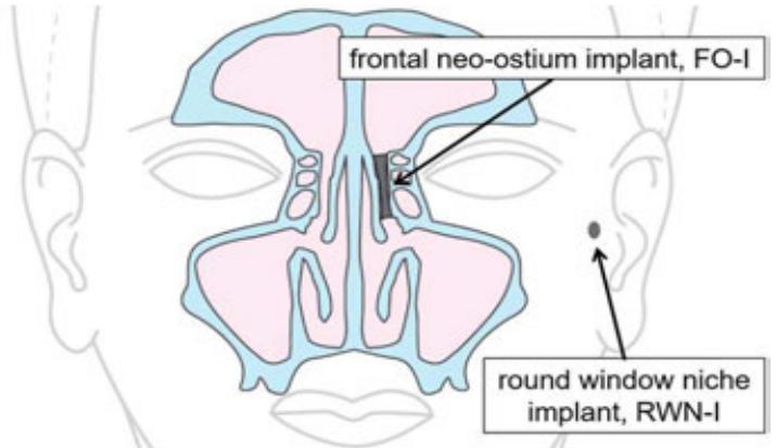 (PDF) Micro injection molding of individualised implants using 3D ...