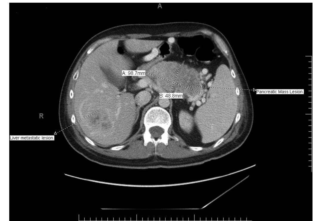 (PDF) Hypokalemic Rhabdomyolysis Due to Watery Diarrhea, Hypokalemia ...
