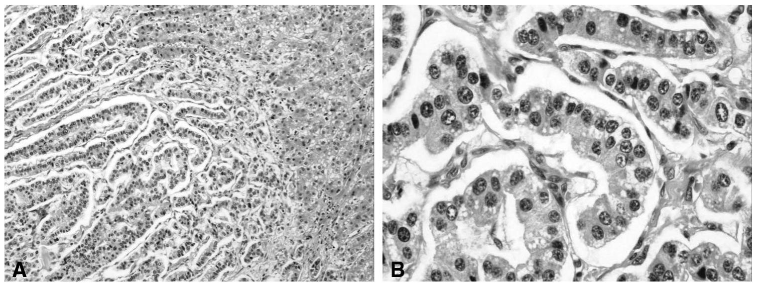 Vipoma Mri (PDF) Hypokalemic Rhabdomyolysis Due to Watery Diarrhea, Hypokalemia ...
