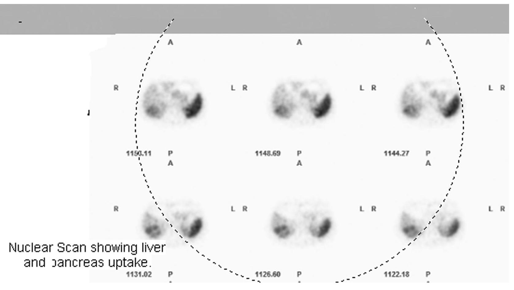 Vipoma Mri (PDF) Hypokalemic Rhabdomyolysis Due to Watery Diarrhea, Hypokalemia ...