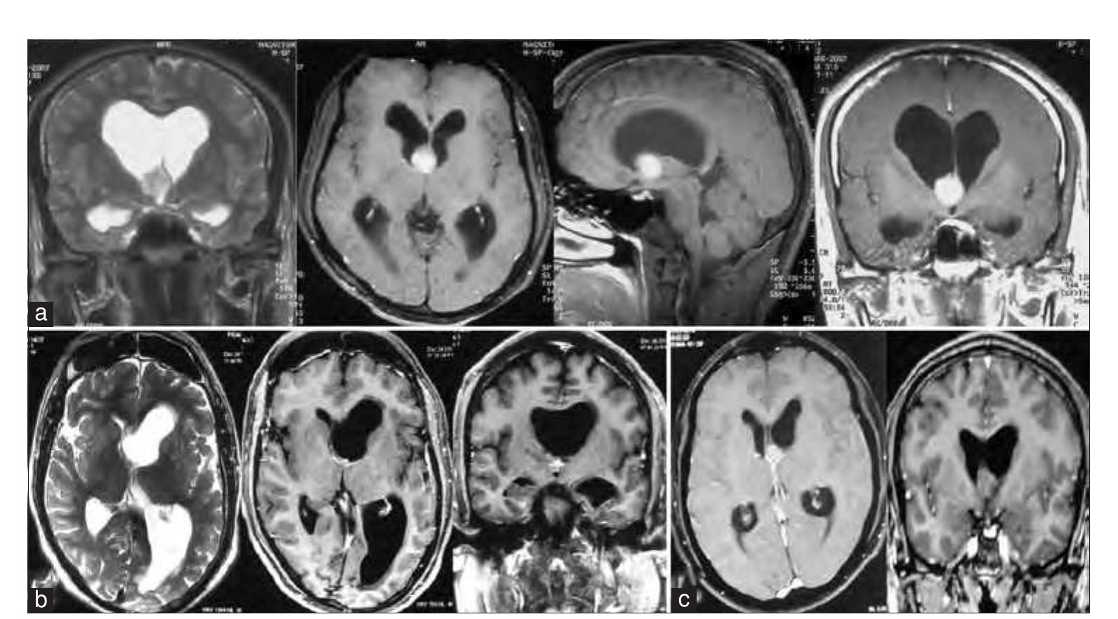 (PDF) Colloid Cysts of the Third Ventricle: A Review of Literature with ...