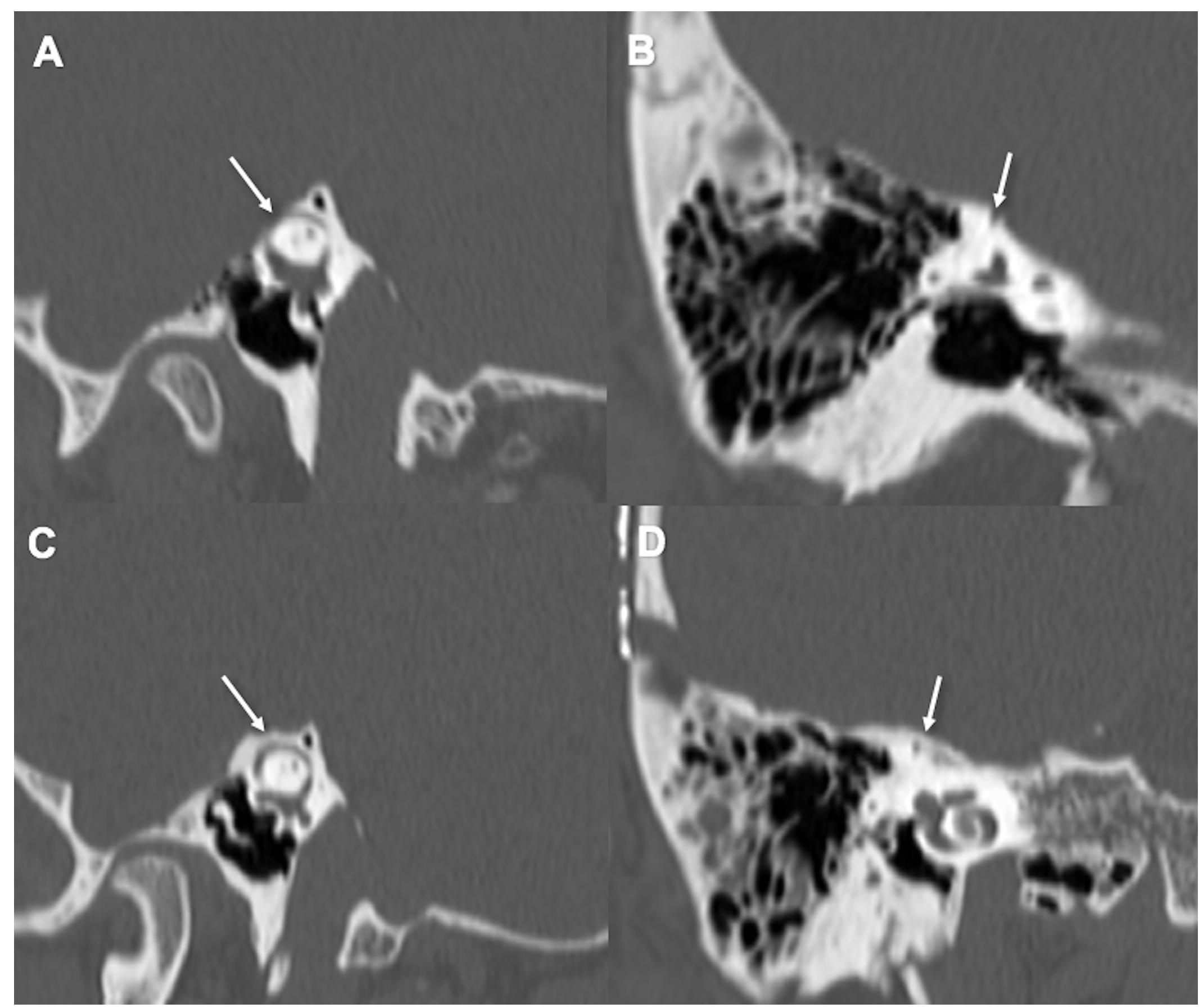 Ig Scan Ig. 1. high resolution axial ct scan of the temporal bone,