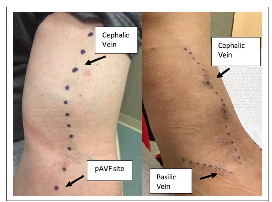 (PDF) Patient selection, education, and cannulation of percutaneous ...