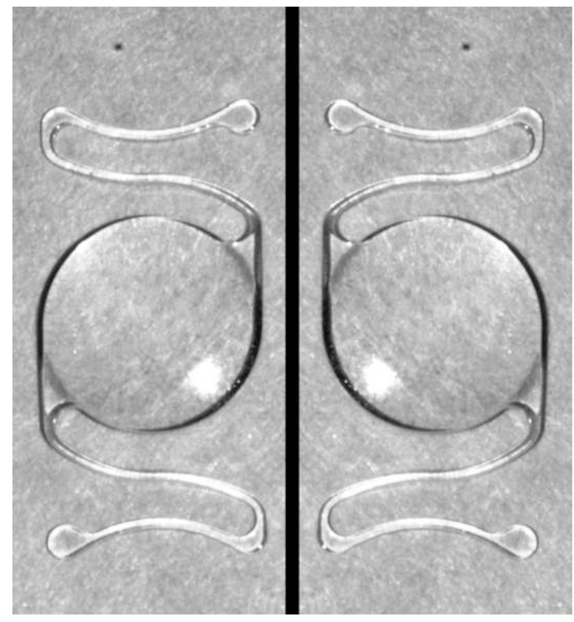Inverted Lens Fixture (PDF) Upside-down Lens Syndrome: Ocular Complications Secondary to ...